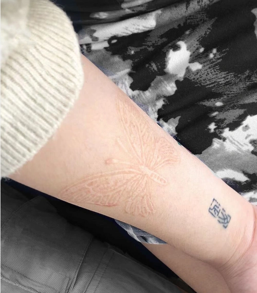 手臂蝴蝶肉雕纹身恢复图超好看的割皮纹身恢复图片欣赏8