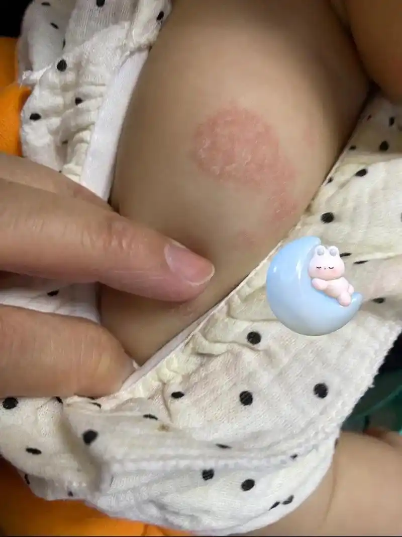 只有宝妈才懂吧 干性湿疹7915特异性皮炎#宝宝湿疹  不求所 - 抖