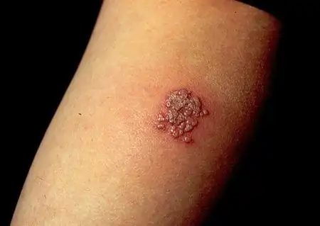 病毒性皮肤病1 - 知乎