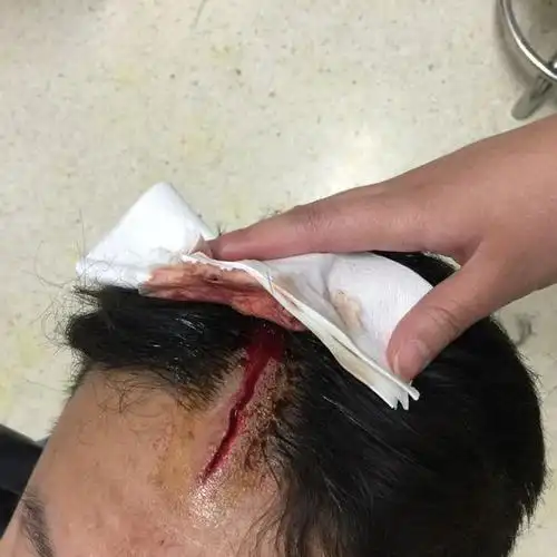 接伤8裂皮连米头伤裂厘轻算害伤