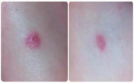 梅毒有什么临床症状