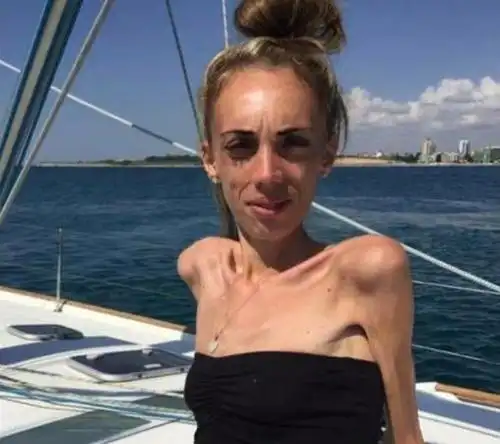 英国23岁姑娘瘦到只有25公斤,全身皮包骨,康复后变女神!