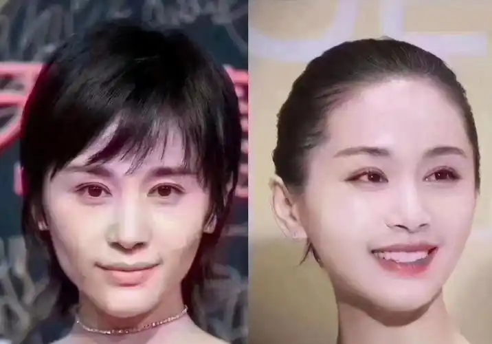 王子文全脸填充变甜美,但你是否提前做好了整容风险的心理准备?