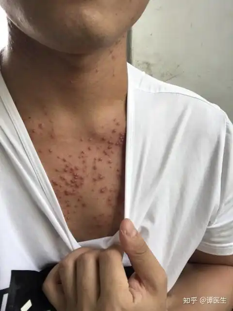 前胸后背都长了很多痘痘