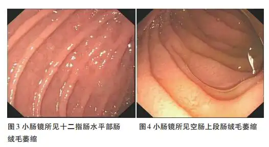 乳糜泻致肠梗阻 1例