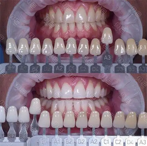 牙齿美白贴面对比图