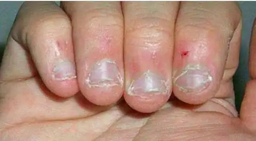 娃从小爱"啃指甲",带娃就医,医生一番话,妈妈后悔看晚了