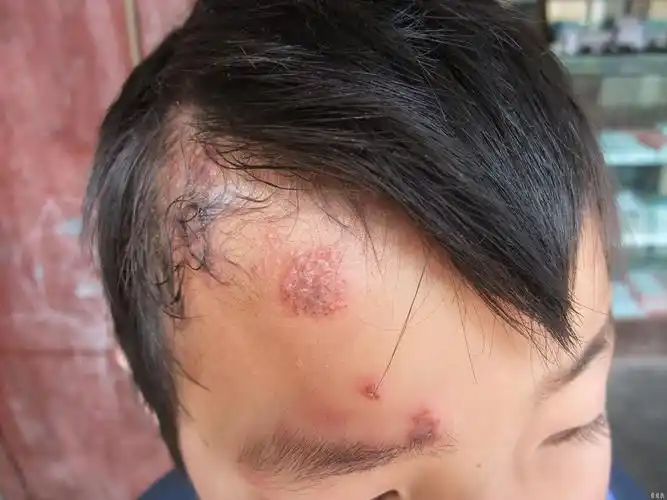 求助皮肤病 - 皮肤及性传播疾病讨论版 - 爱爱医医学论坛