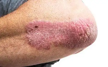 早期牛皮肤癣图片初期症状怎么引起的治疗牛皮肤癣光疗的药膏药物