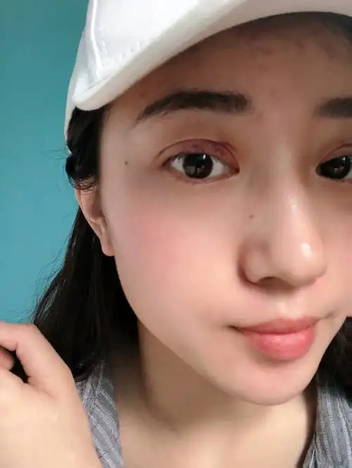 做完埋线双眼皮五天了,第一次接触医美感觉还挺好的,_圈子-新氧美容
