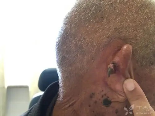 体格检查:右侧耳后可见角状突起 辅助检查: 临床诊断:耳廓肿物 治疗