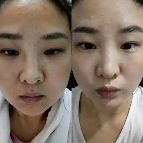 真人美白祛斑效果对比!