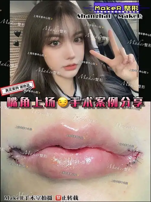 嘴角上扬91手术案例分享_圈子-新氧美容整形