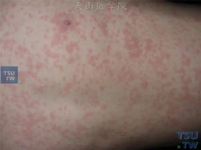 麻疹(measles)症状表现 - 皮肤病学 - 天山医学院