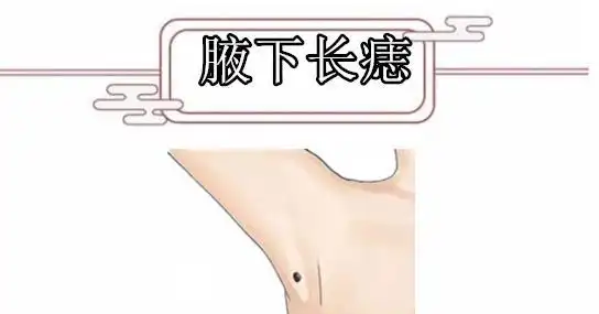 1,女人左腋下长痣女人左腋下长痣,代表桃花旺,很容易被别人暗恋,因为