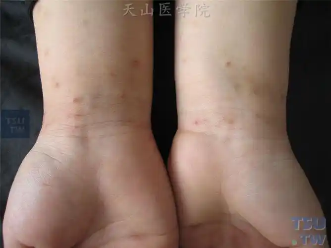 疥疮(scabies)的症状表现