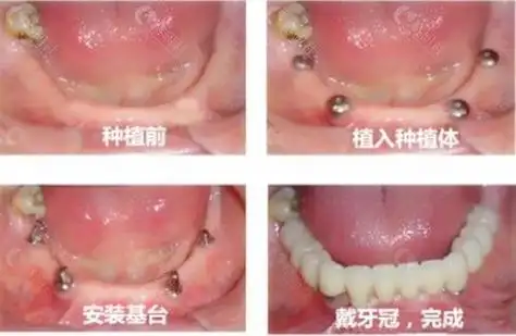 全口种植牙过程图解