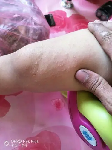 麻烦大神指点一下这是什么皮肤病?