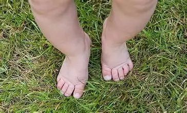 孩子走路八字脚如何运动康复矫正