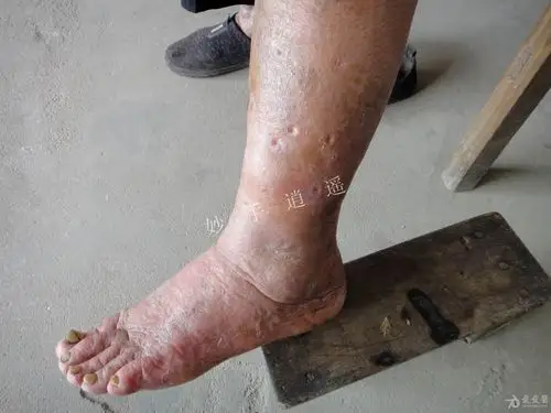 请问有谁看过这种皮肤病?(有点恶心) - 皮肤及性传播疾病讨论版 - 爱