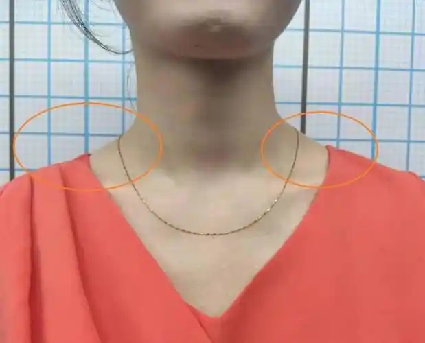 体态训练(一):女生如何减斜方肌?