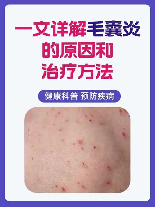 一文详解毛囊炎的原因和治疗方法!