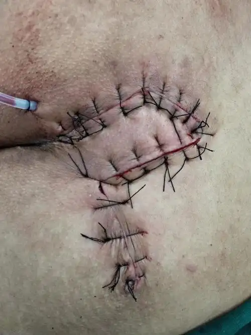 完整切除炎性窦道,可见到窦道内毛发.