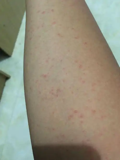 现在身上也慢慢出现,很痒,最近刚到福建二十天请问是水土不服,还是