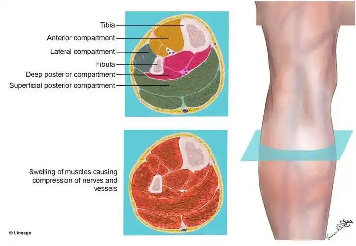 不断增大的"气球"——胫前间隔综合征_肌肉_小腿_神经