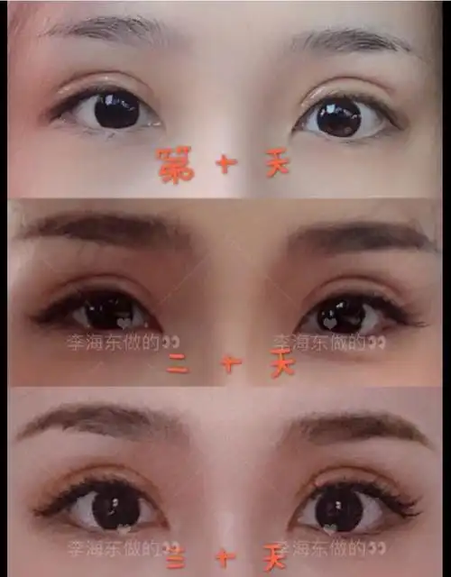 73今日案例-全切双眼皮平行7.5mm患者术前肿眼泡_圈子-新氧美容整形