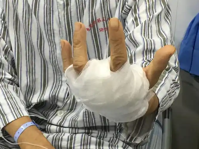 提醒就因为被鱼刺扎了一下手最后只能截肢保命爱吃海鲜的注意了