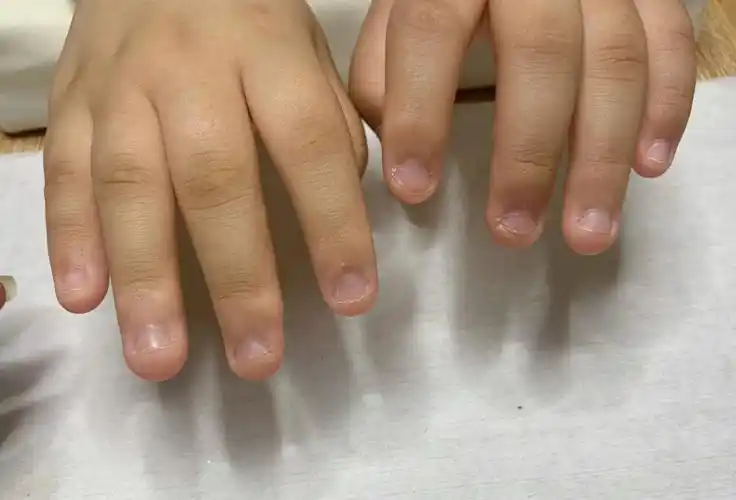 啃咬甲矫正习惯咬指甲的姐妹千万不要放弃