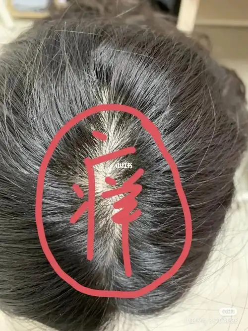 就头顶这块痒起头皮屑的姐妹能不能告诉我一下你们是怎么解决的