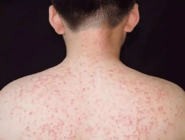 背后长的红疙瘩是痘痘还是毛囊炎为什么总是去不掉