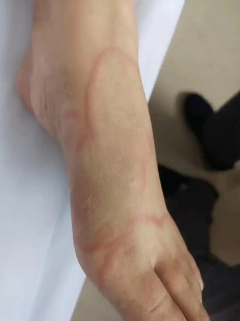 分享一例龙虾过敏后全身皮肤反应吧.圆圈圈, - 抖音