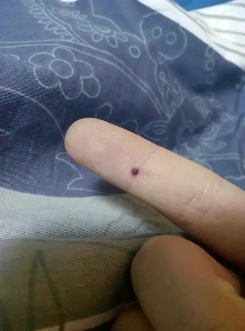 手上突然长了一颗黑痣,略大,凸起,昨天中午突然发现,前天还没发觉