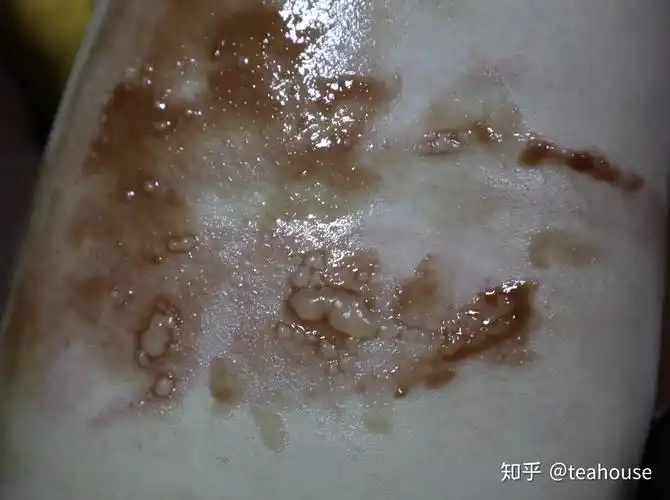 记一次开水烫伤