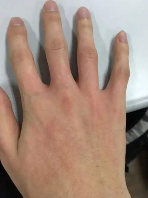 手上长了这样的疹子
