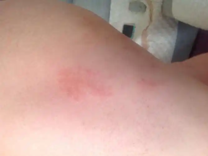 为什么天气一热身上就痒或者运动的时候(为什么天气一热身上就痒或者