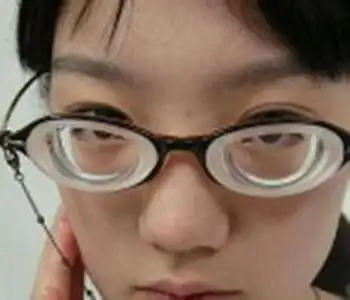 高度疑难屈光近视2300度做成超美薄眼镜效果怎么样