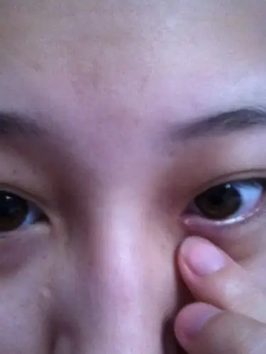 眼睛上半个月前长了个小白点.