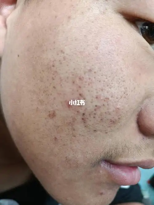 油皮毛孔粗大黑头粉刺