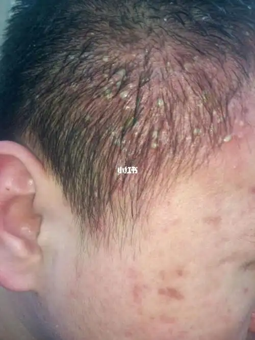 毛囊炎怎么才能好