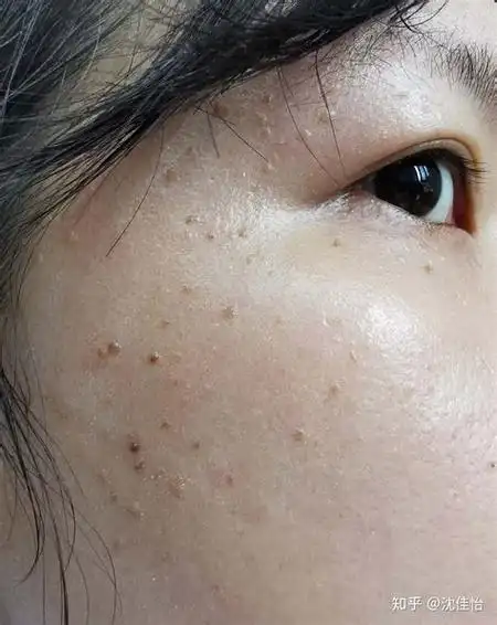 扁平疣是一种常见的皮肤疾病,通常是由人体乳头状瘤病毒(hpv)感染所