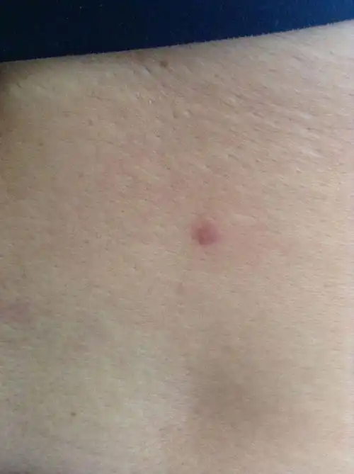 我母亲今年56岁,后腰在四五个月前长了一颗硬疙瘩