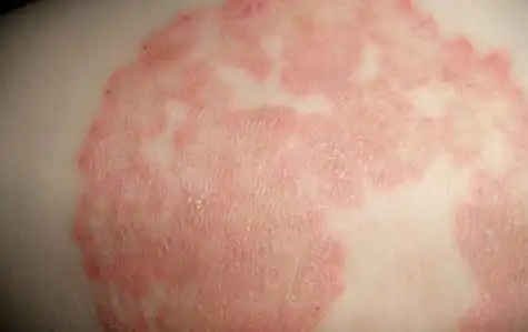 过敏性湿疹怎么治疗-杏林教育