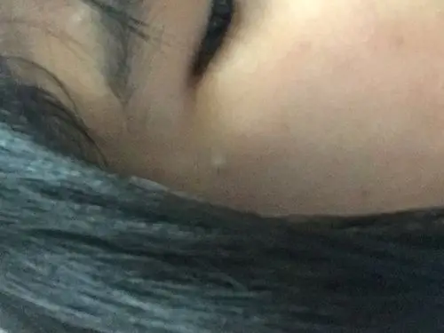 我女儿眼睛后面长了一颗小肉粒,不痒不痛,颜色是肤色,已经有一_皮肤科