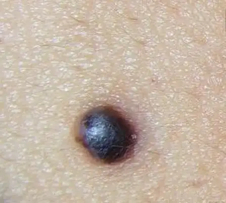 不典型色素痣图片_色素痣