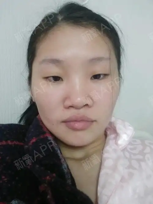 天生大鼻头,宽鼻翼本身想外收鼻翼效果比较明显.