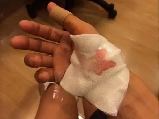 闫鑫泷微博曝受伤照 直面回应网友炒作质疑(图)